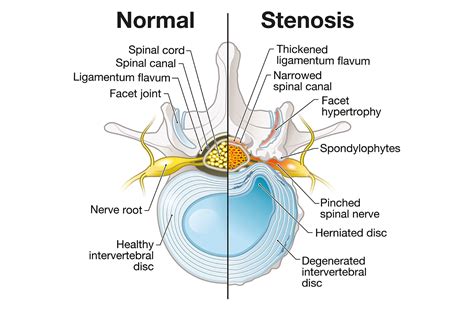 In this treatment, Dr. . Homeopathy for canal stenosis